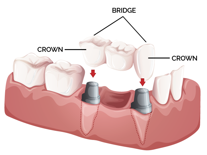 Dental Crown & Bridge